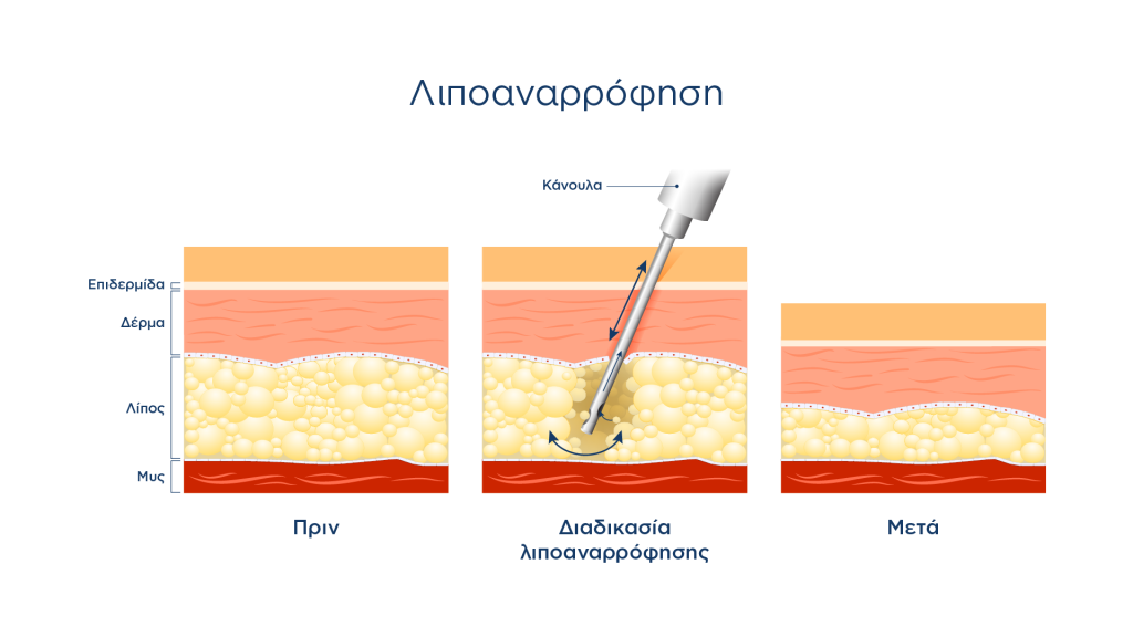 Θεραπεία Λιποιδήματος με Λιποαναρρόφηση - Διαδικασία