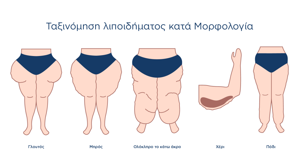Θεραπεία Λιποιδήματος με Λιποαναρρόφηση - Ταξινόμηση λιποιδήματος κατα μορφολογία